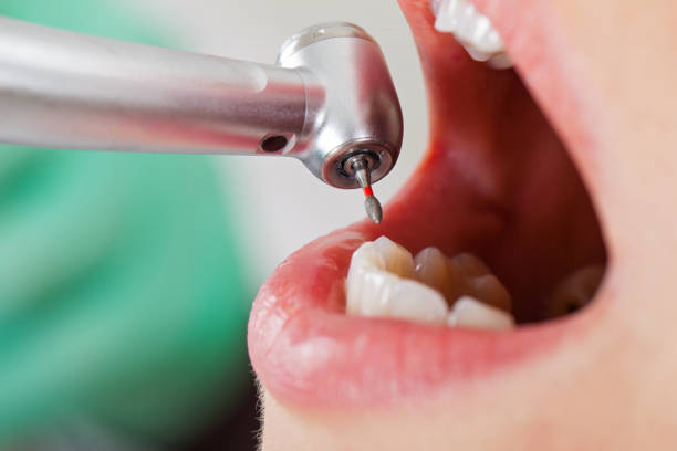 Best Emergency Dentist for Knocked-Out Tooth in Omro, WI